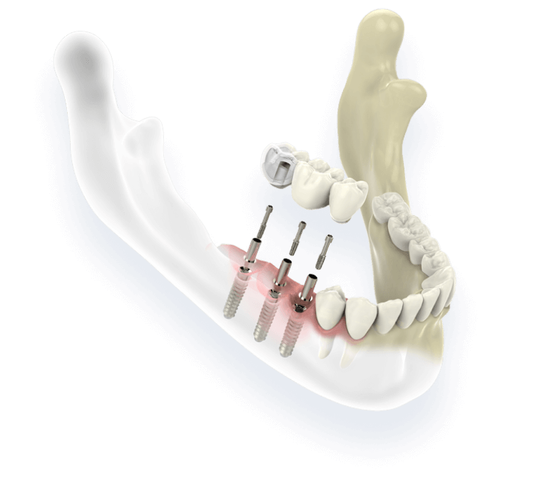 How dental implants work