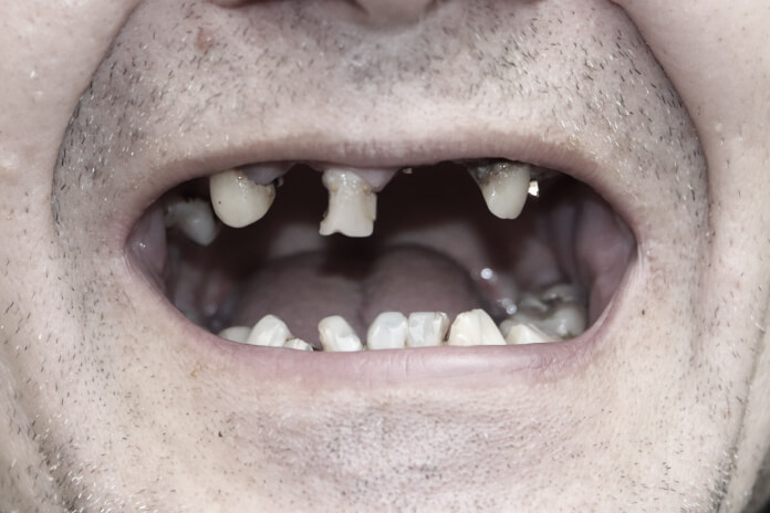 A patient's smile before receiving dental treatment from our Grundy Center, IA Dentist
